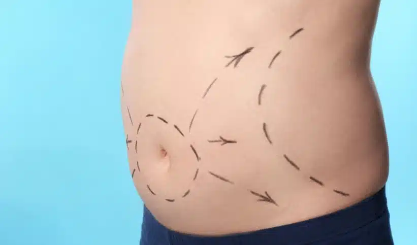 Dans quels cas une abdominoplastie est-elle envisageable