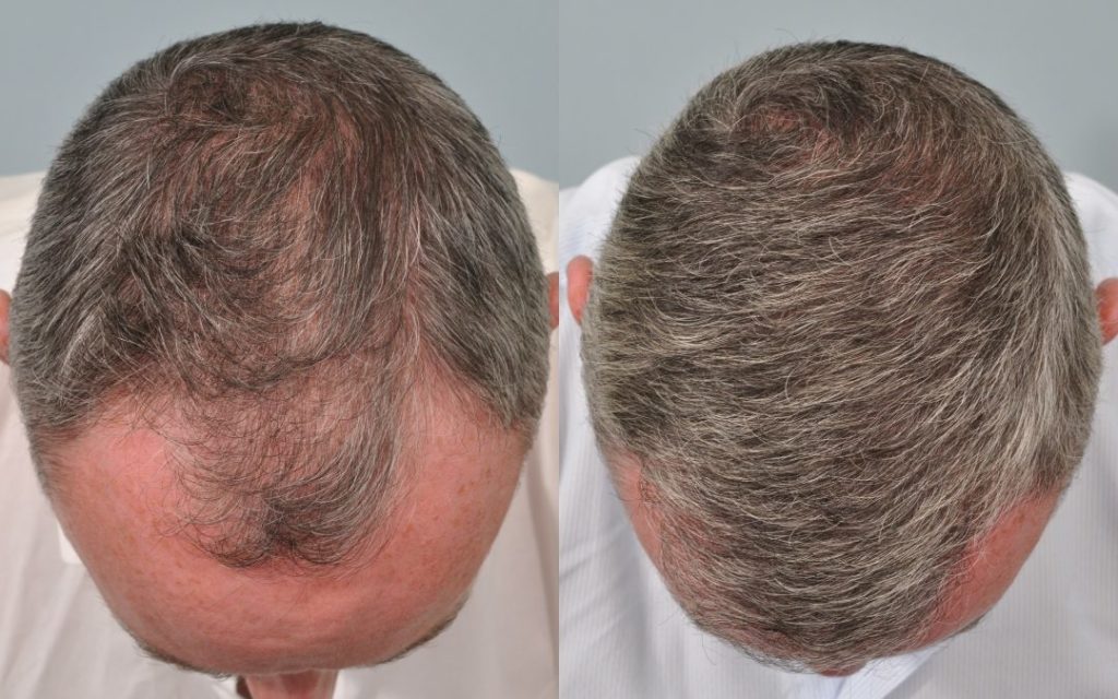 greffe de cheveux
